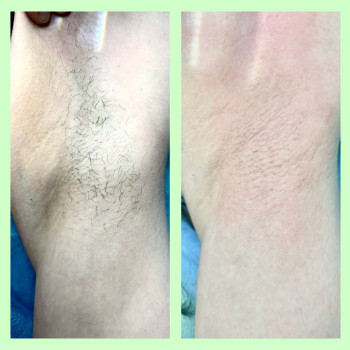 Депіляція воском