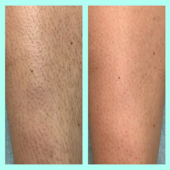 Депіляція воском