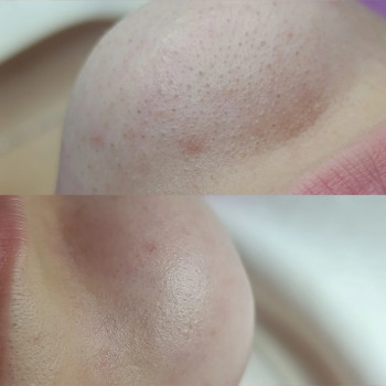 Чистка_лица