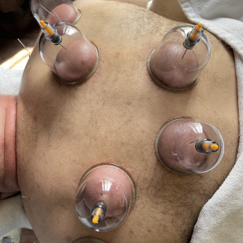 Вакуумноградиентная терапия+аккпунктура