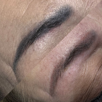 Результат одного видалення. Будемо видаляти далi. готую брови до перекриття. Шкіра після видалення має бути здоровою