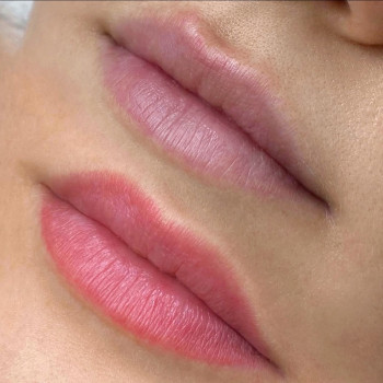 губи до і після загоїлися