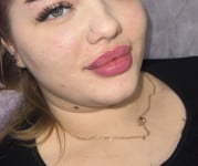 Увеличение губ Косметологічний центр Laser Kosmo Запоріжжя