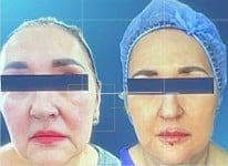 Колагеностимуляція PLLA PETARAN Косметологический центр Laser Kosmo Запорожье