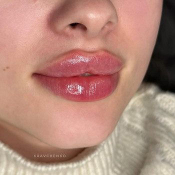 Збільшення губ гіалуроновою кислотою