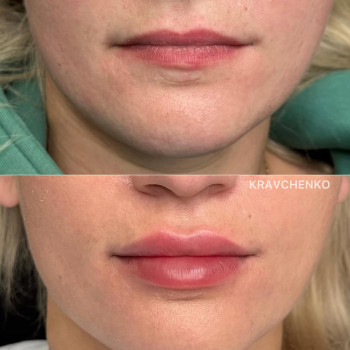 Збільшення губ гіалуроновою кислотою