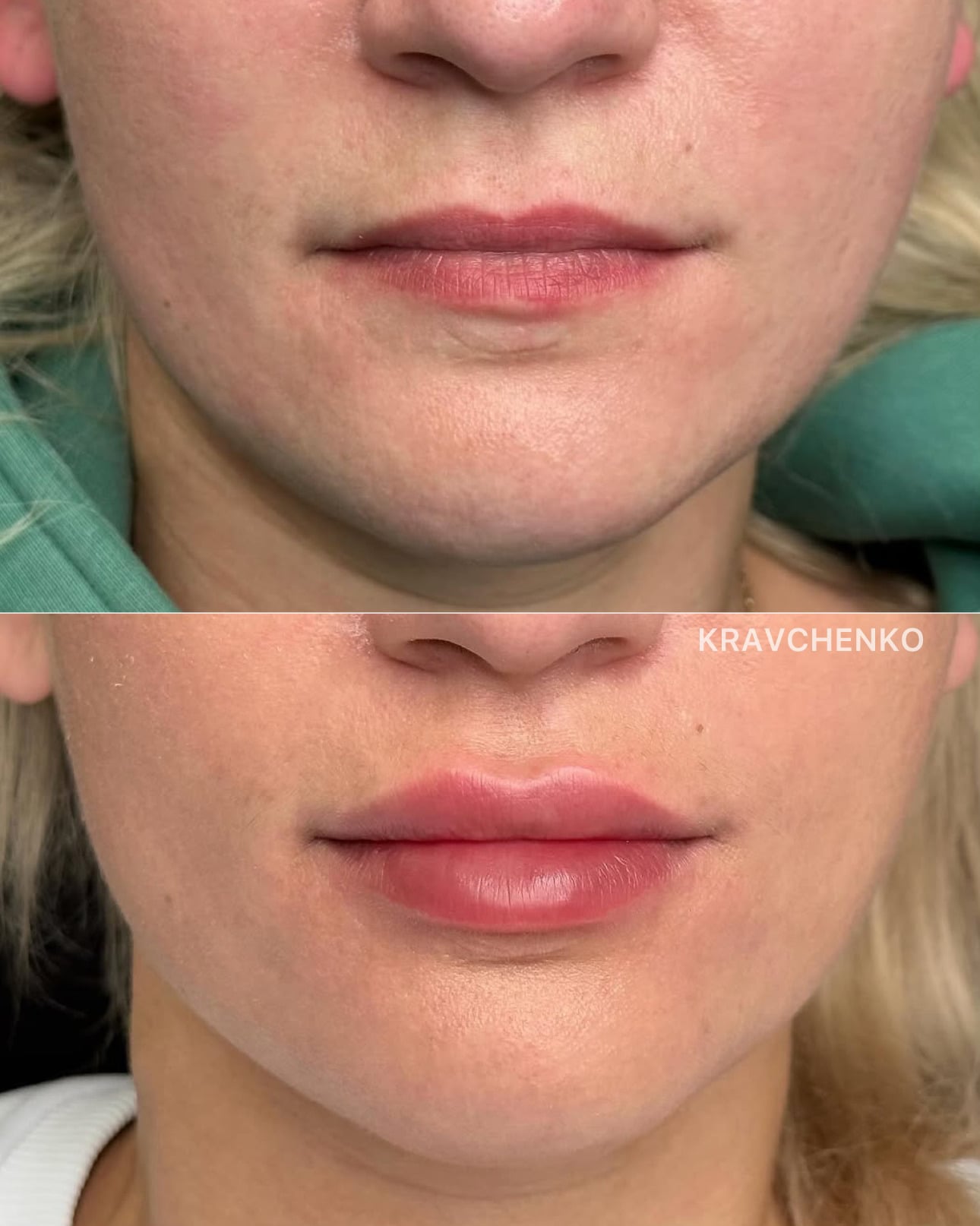 Збільшення губ гіалуроновою кислотою, фото - Врач-косметолог Филипп Кравченко