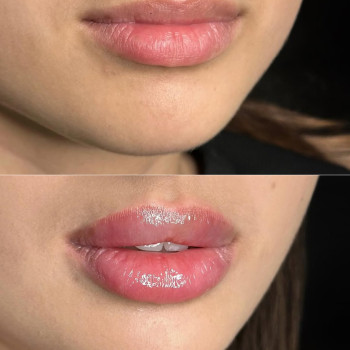 Збільшення губ гіалуроновою кислотою