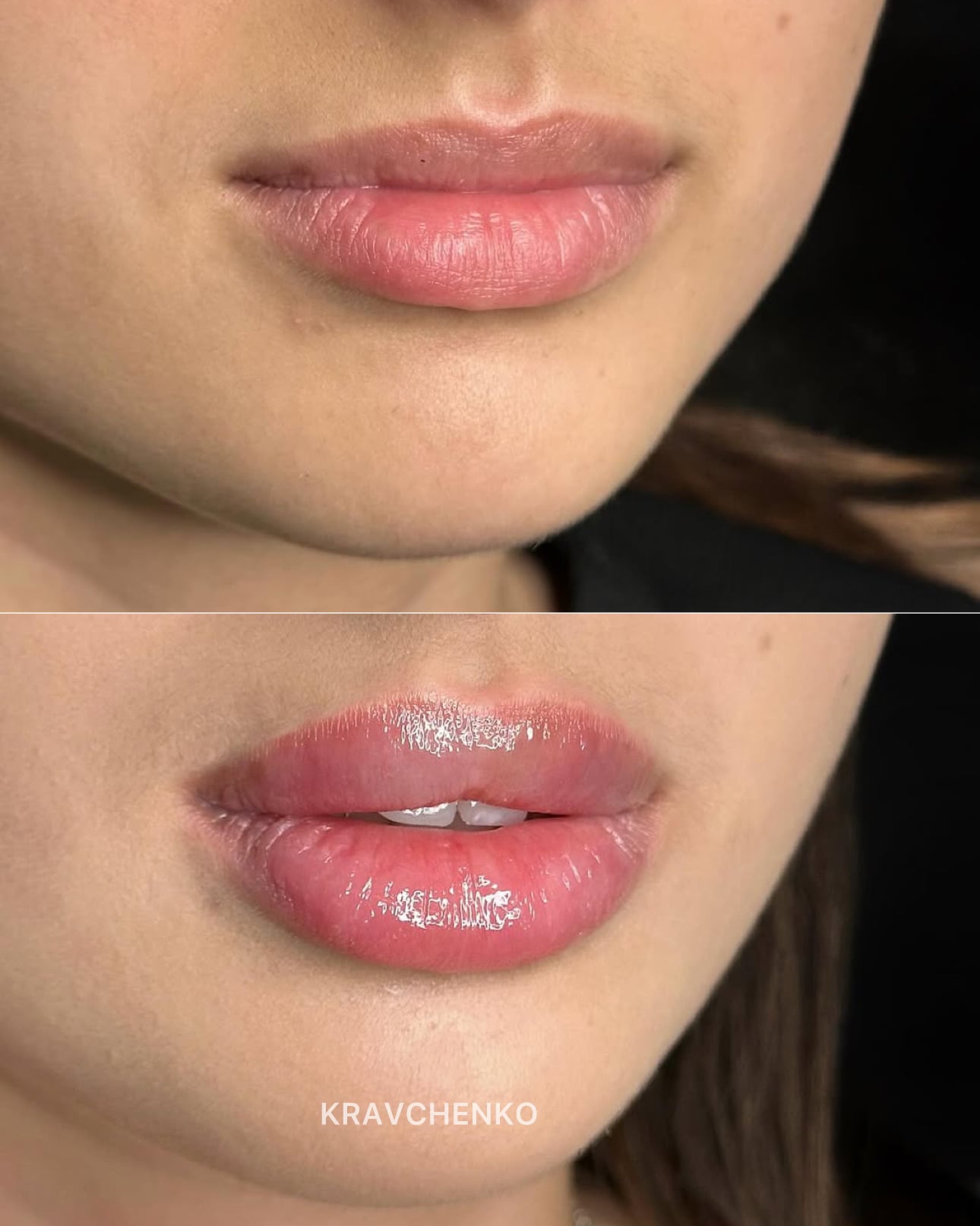 Збільшення губ гіалуроновою кислотою, фото - Врач-косметолог Филипп Кравченко