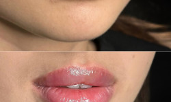 Увеличение губ гиалуроновой кислотой Лікар-косметолог Филипп Київ