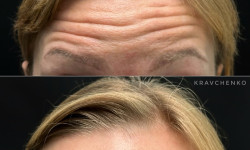 Ботокс в лоб Лікар-косметолог Филипп Київ