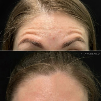 Ботокс у чоло | Ботокс в лоб