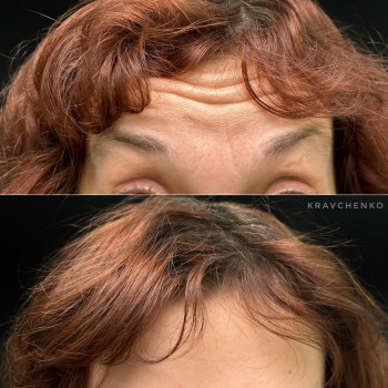 Ботокс у чоло | Ботокс в лоб