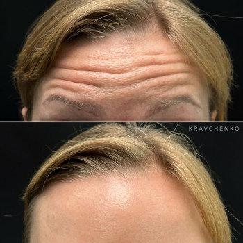 Ботокс у чоло | Ботокс в лоб