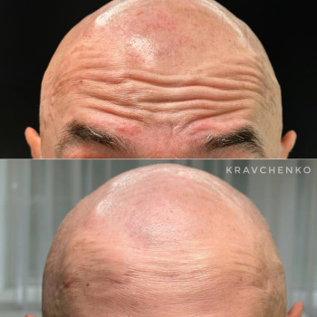 Ботокс у чоло | Ботокс в лоб