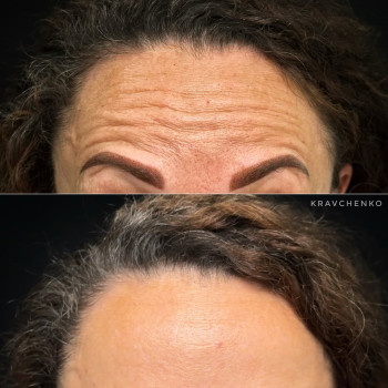 Ботокс у чоло | Ботокс в лоб