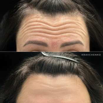 Ботокс у чоло | Ботокс в лоб