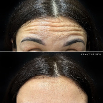 Ботокс у чоло | Ботокс в лоб