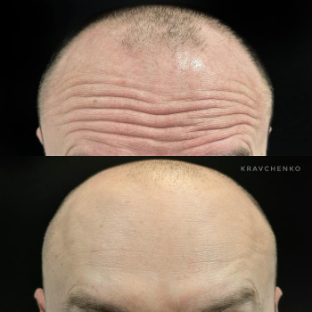 Ботокс у чоло | Ботокс в лоб