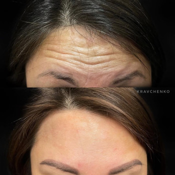 Ботокс у чоло | Ботокс в лоб