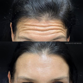 Ботокс у чоло | Ботокс в лоб