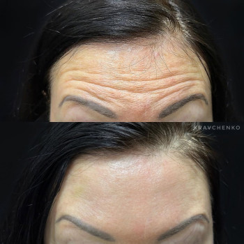 Ботокс у чоло | Ботокс в лоб