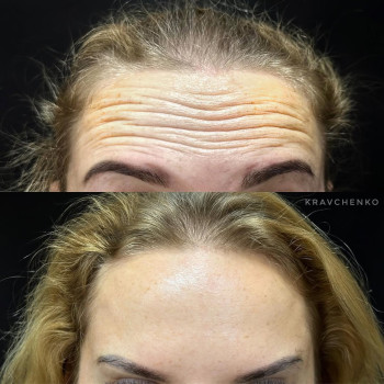 Ботокс у чоло | Ботокс в лоб