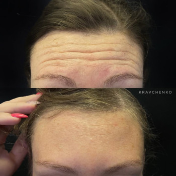 Ботокс у чоло | Ботокс в лоб