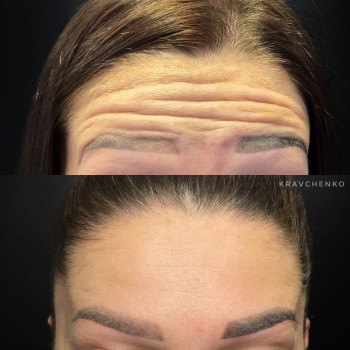 Ботокс у чоло | Ботокс в лоб