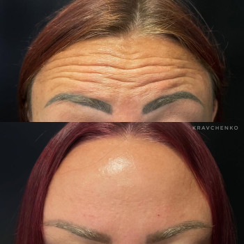 Ботокс у чоло | Ботокс в лоб