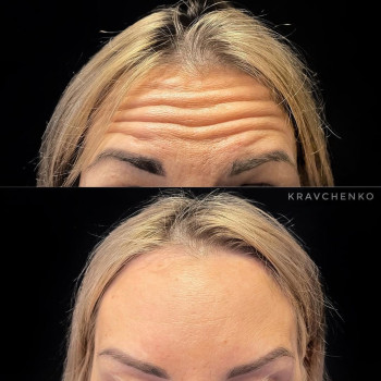 Ботокс у чоло | Ботокс в лоб