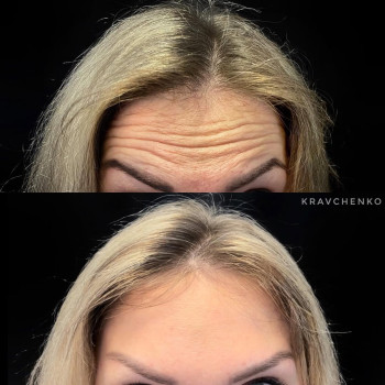 Ботокс у чоло | Ботокс в лоб