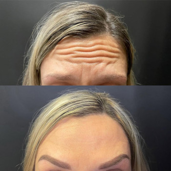 Ботокс у чоло | Ботокс в лоб