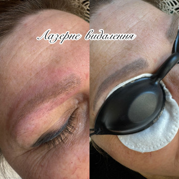 Результат одного видалення. Будемо видаляти далi. готую брови до перекриття. Шкіра після видалення має бути здоровою