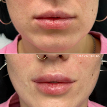 Збільшення губ філером