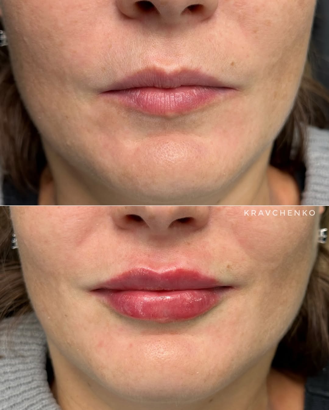 Збільшення губ філером, фото - Лікар-косметолог Філіпп Кравченко