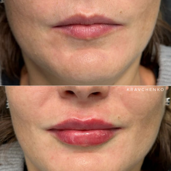 Збільшення губ філером