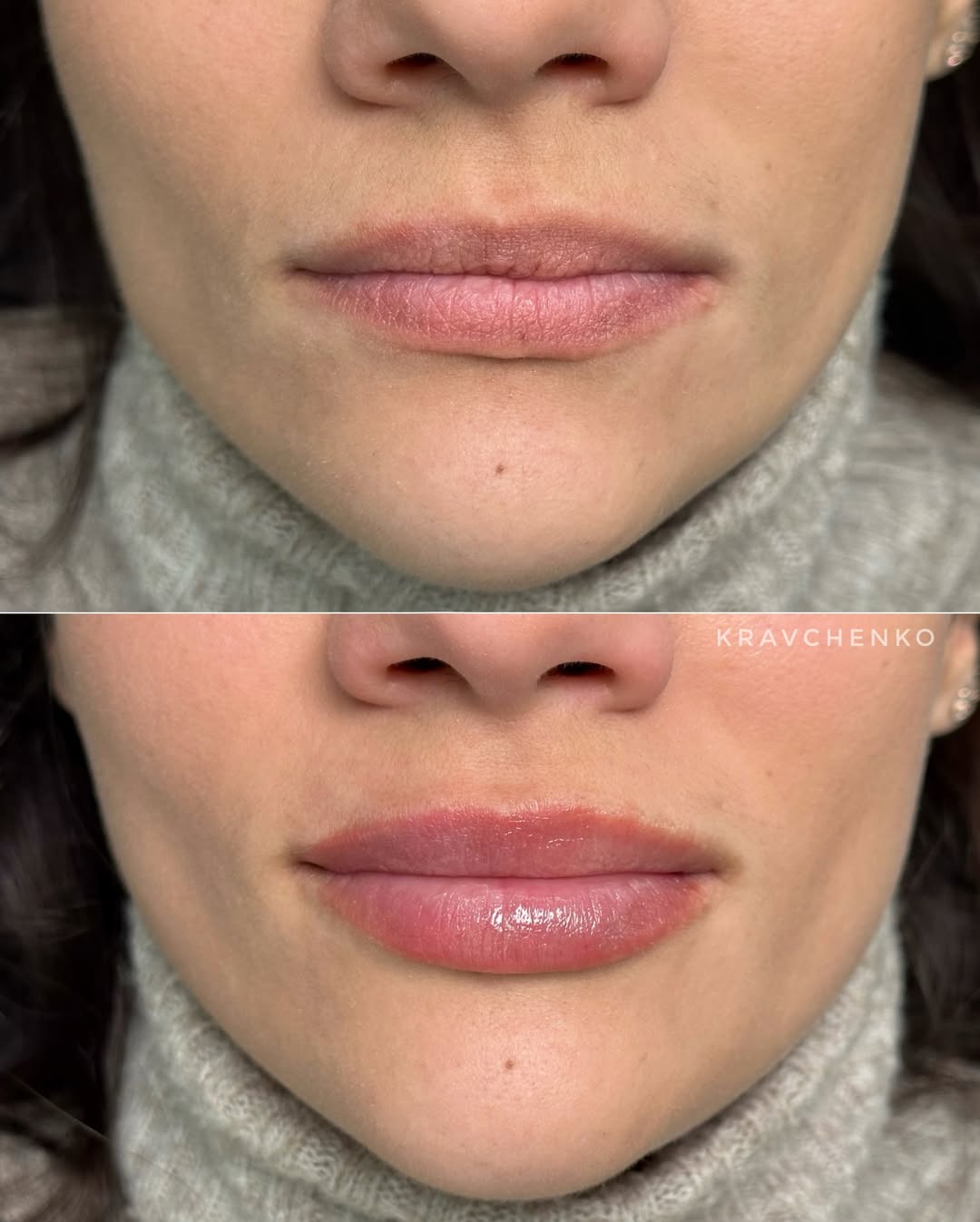 Збільшення губ філером, фото - Лікар-косметолог Філіпп Кравченко