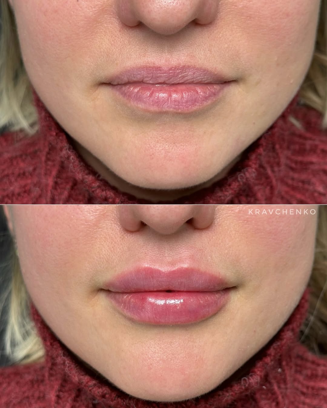 Збільшення губ філером, фото - Врач-косметолог Филипп Кравченко