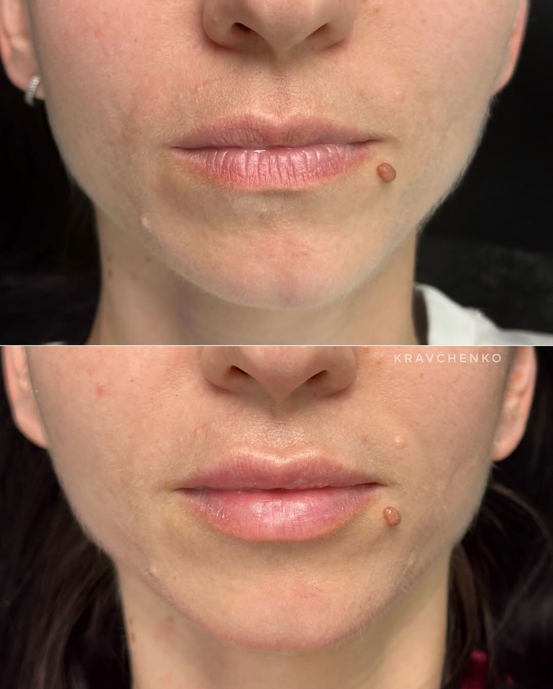 Збільшення губ філером, фото - Врач-косметолог Филипп Кравченко