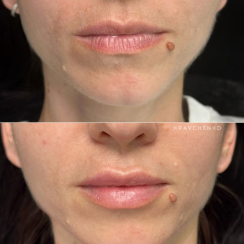 Збільшення губ філером