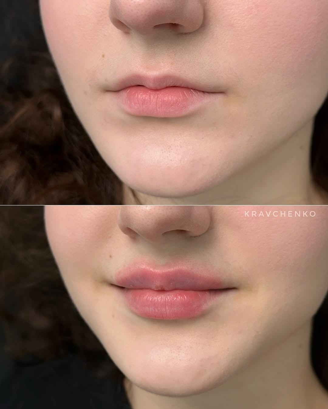 Збільшення губ філером, фото - Врач-косметолог Филипп Кравченко