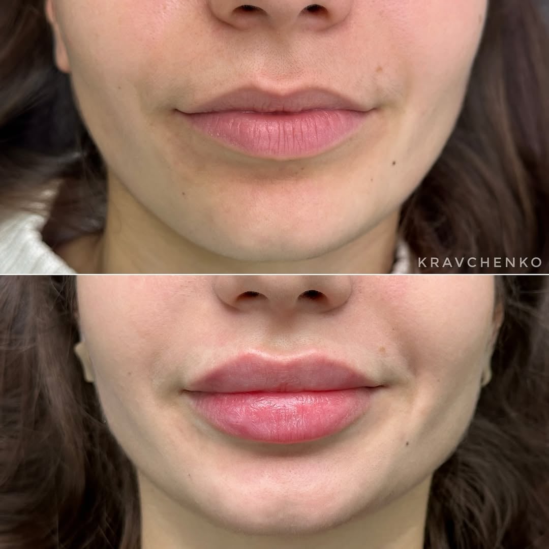 Збільшення губ філером, фото - Врач-косметолог Филипп Кравченко