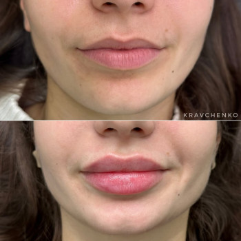 Збільшення губ філером