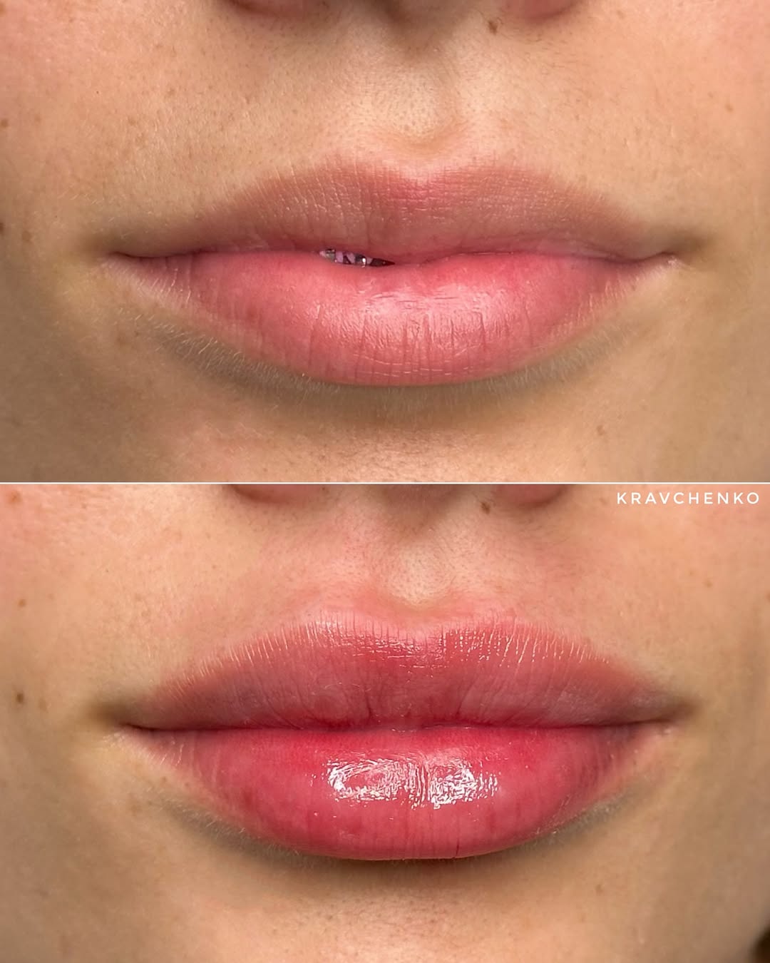 Збільшення губ філером, фото - Врач-косметолог Филипп Кравченко