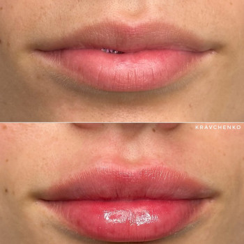 Збільшення губ філером