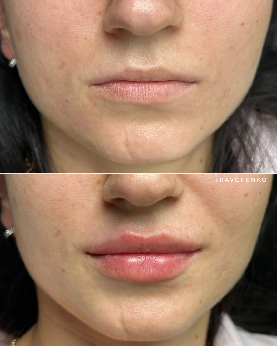 Збільшення губ філером, фото - Врач-косметолог Филипп Кравченко