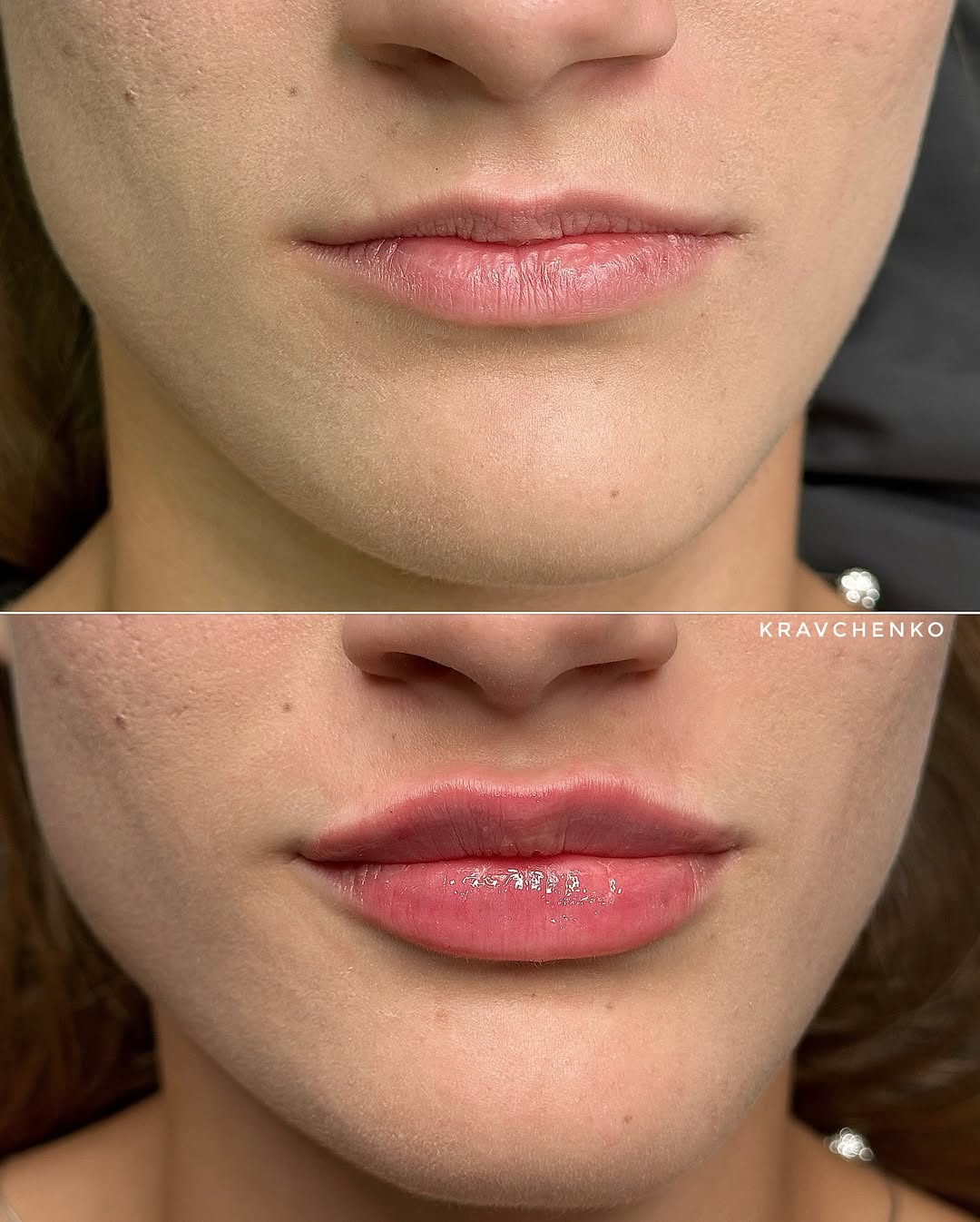 Збільшення губ філером, фото - Врач-косметолог Филипп Кравченко