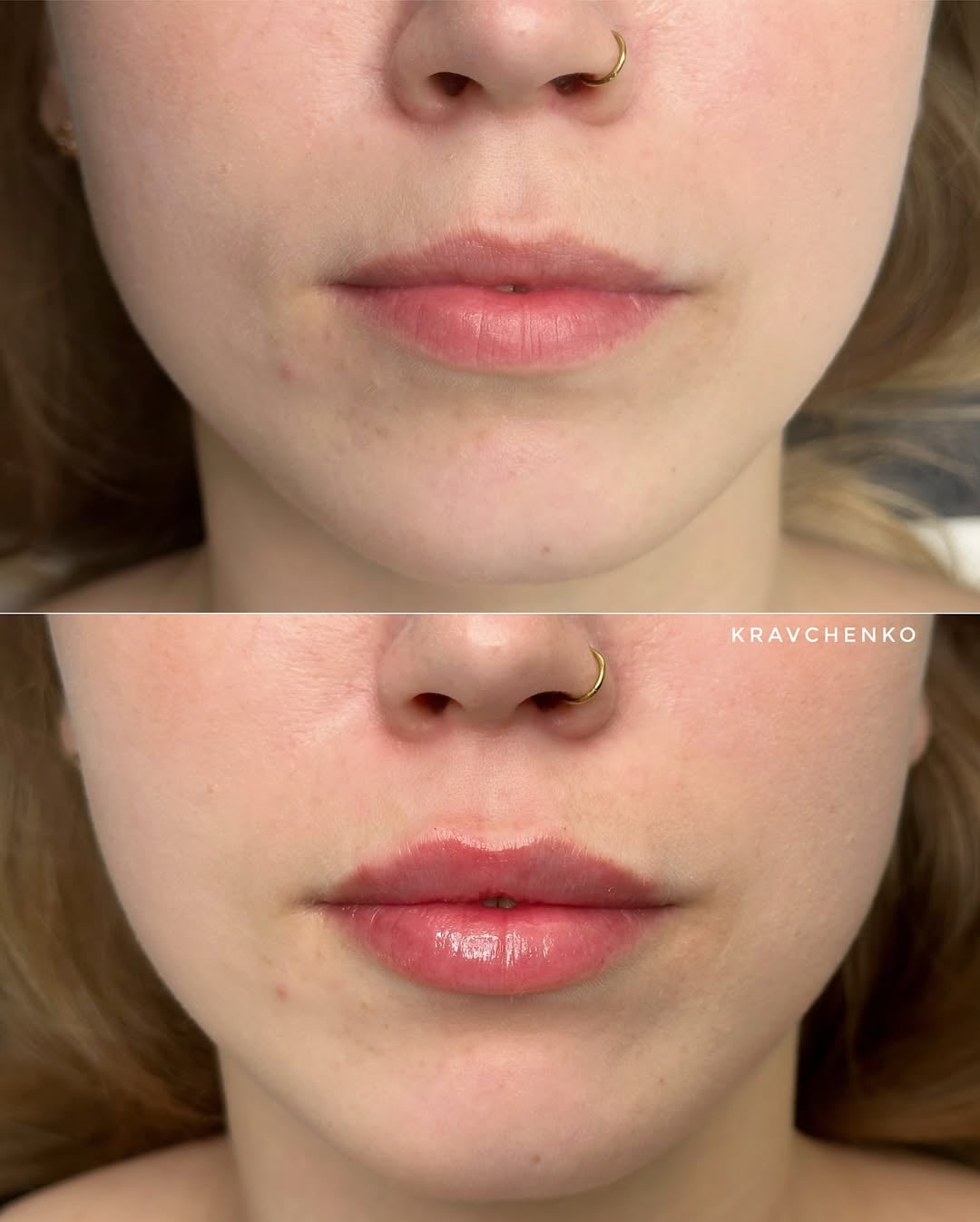 Збільшення губ філером, фото - Врач-косметолог Филипп Кравченко