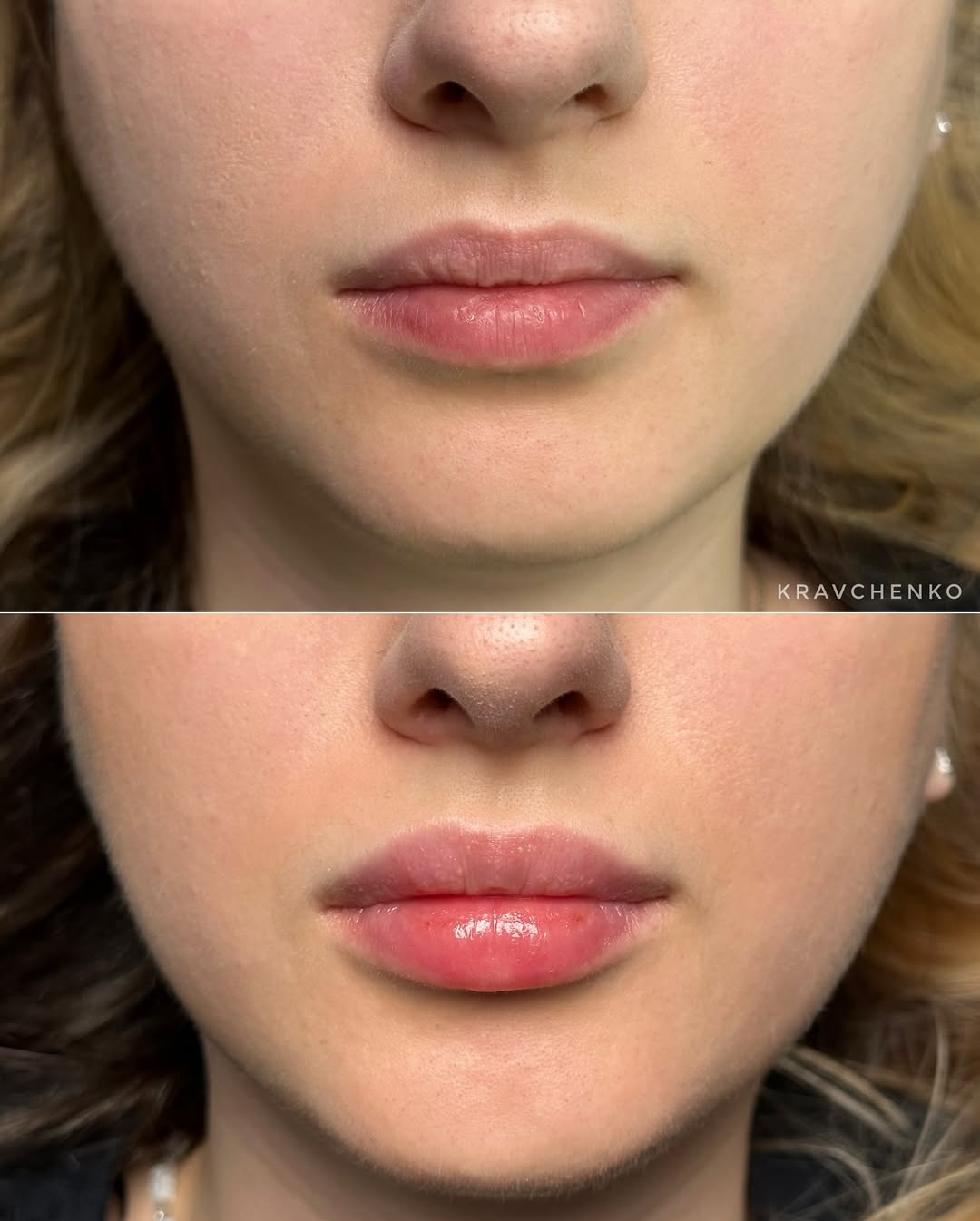 Збільшення губ філером, фото - Врач-косметолог Филипп Кравченко
